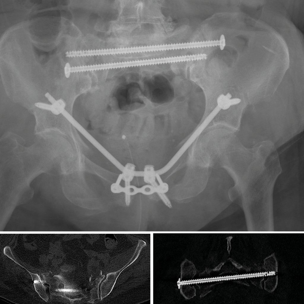 Die Navigation in der Beckenchirurgie mittels LOOPX Orthopädie